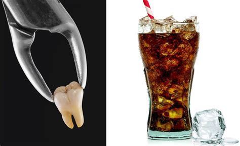 Carbonated Drinks Tooth Extraction