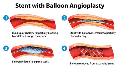 cardiac cath with pci means