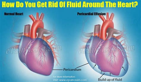 Understanding Cardiac Fluid Around Heart: Causes and Implications Revealed