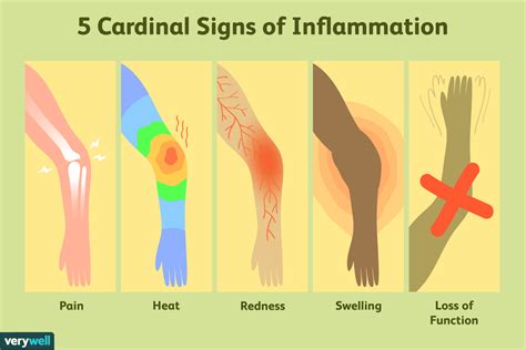 The four cardinal signs of inflammation Malaghan