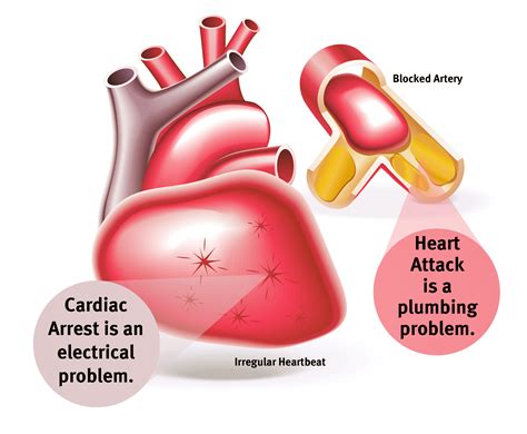 10 Facts About Cardiac Arrest Many People Don’t Know About