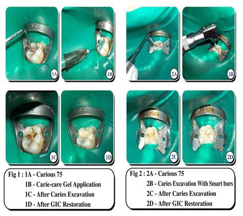 Caries Excavation Dental Code