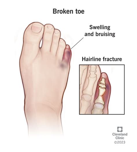 Healing on the Right Track: Essential Tips for Caring for a Broken Toe