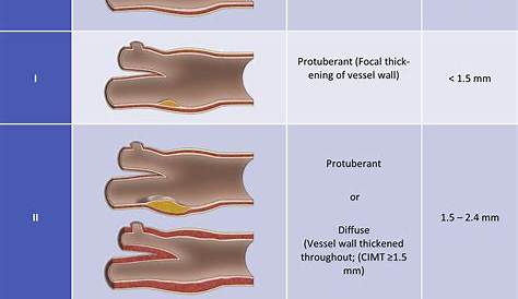 Carotid Plaque Morphology Examples Of Different Luminal Of The