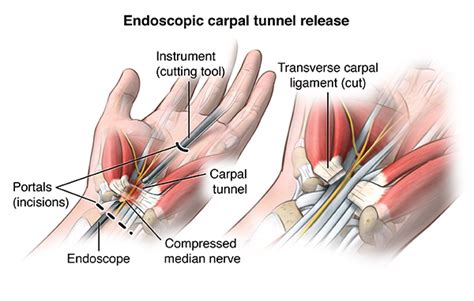 Effective Carpal Tunnel Release: Say Goodbye to Wrist Pain