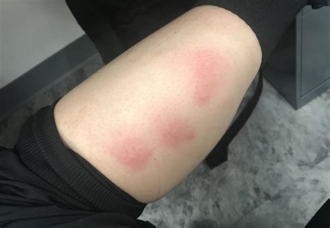 Carpet Beetle Dermatitis Reddit