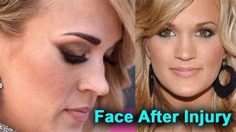 carrie underwood face injury