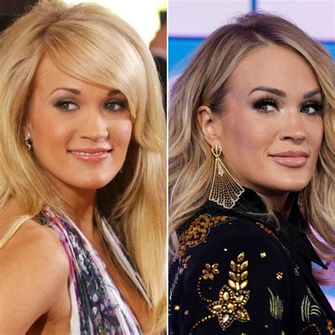 carrie underwood surgery face