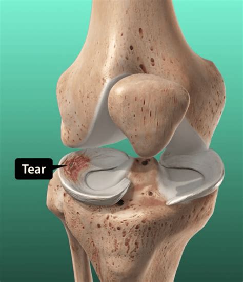 Cartilage Damage Knee