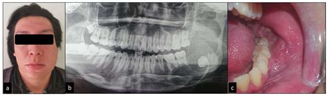 Case Report Ameloblastoma