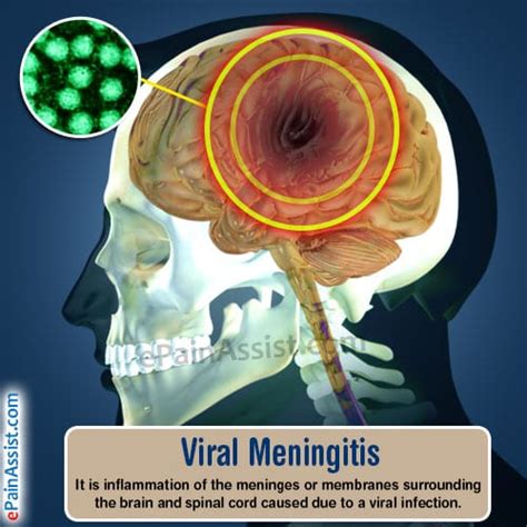 case scenario of viral meningitis