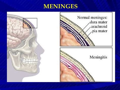case study on meningitis