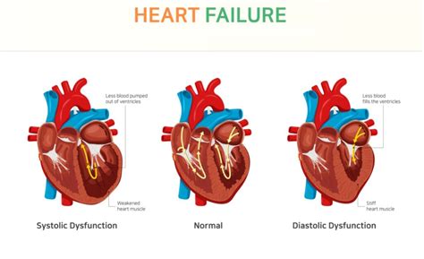 Cases Diastolic Heart Failure