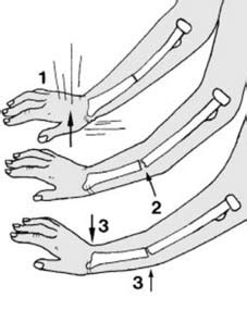 Casting Fracture Techniques