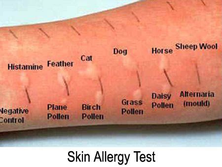 cat allergy test
