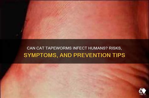 Cat Flea Tapeworm Humans