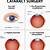 cataract surgery diagram