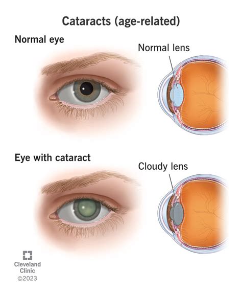 cataract etiology of the word