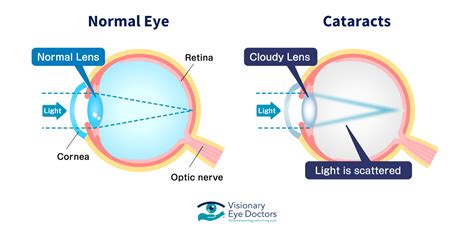 Cataract Eye Pressure