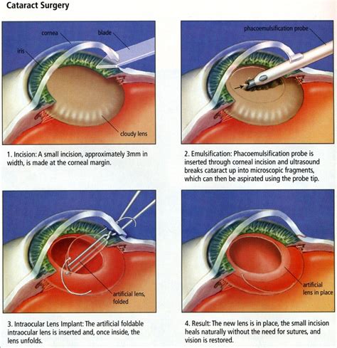 cataract eye surgery after care