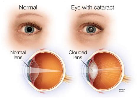 Cataract Eye Video