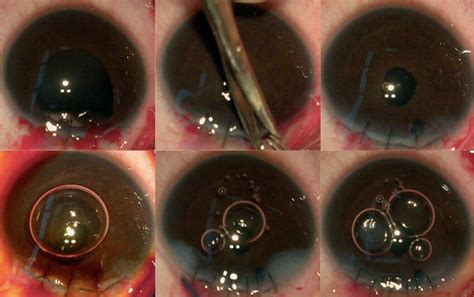 Cataract Operation Icd 10