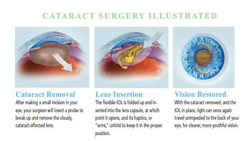 cataract surgery bay area