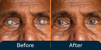 Cataract Surgery Before After