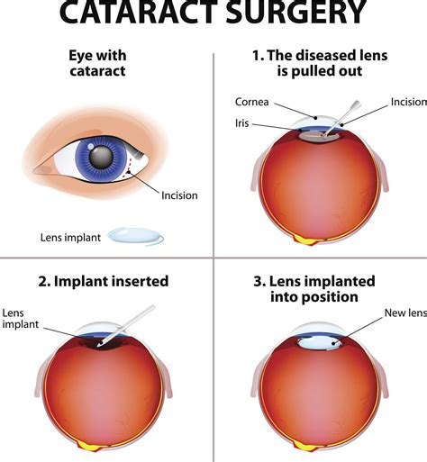 cataract surgery complications nhs