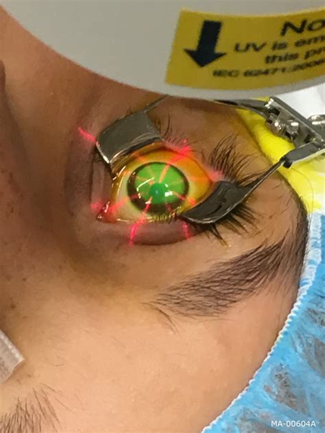 cataract surgery for keratoconus patients