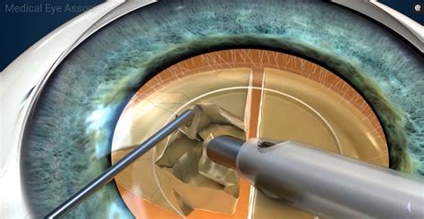 cataract surgery in halifax