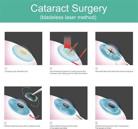 cataract surgery procedure laser vs non laser