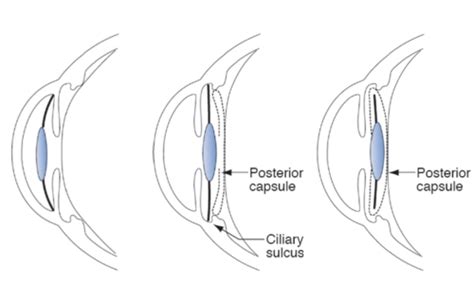 Cataract Surgery Quizlet