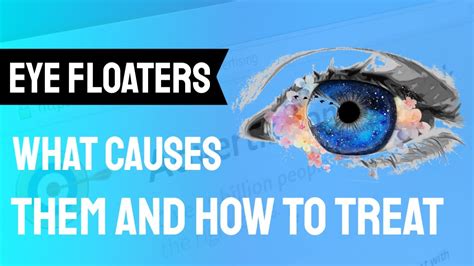 cataract surgery side effects floaters
