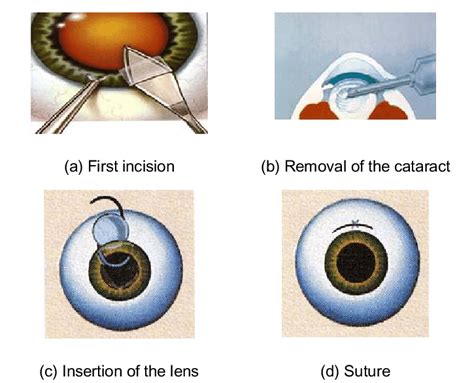 Cataract Surgery Steps