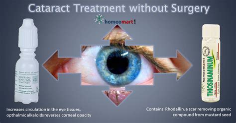 cataract treatment without surgery 2021