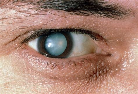 cataracts eyes symptoms