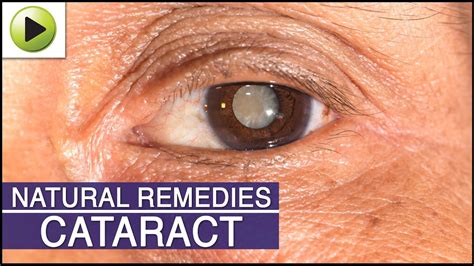 cataracts treatment at home
