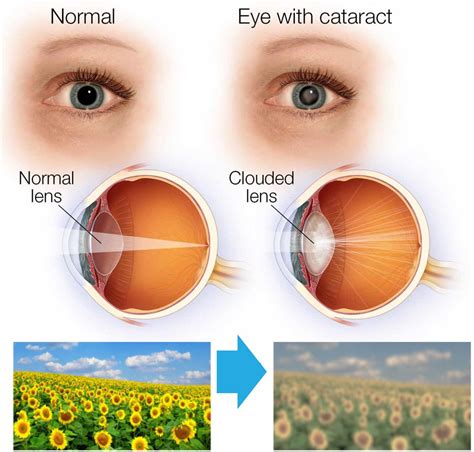 cataracts vision