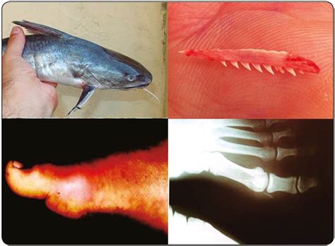 Catfish Sting Swelling
