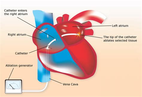 catheter ablation of cardiac arrhythmias