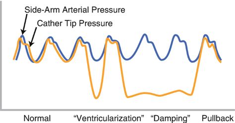 Catheter Damping