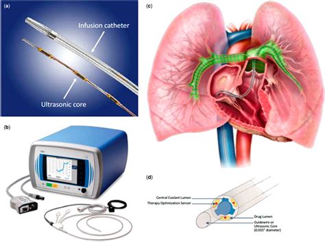 Catheter Embolectomy