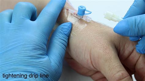 Catheter For Iv Drip