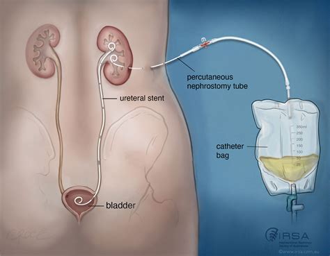 Catheter One Kidney