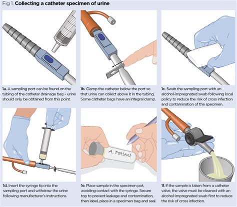 catheter urine sample collection