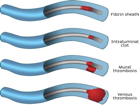 catheter-related thrombosis