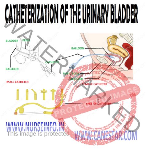 Catheterization Bladder Procedure