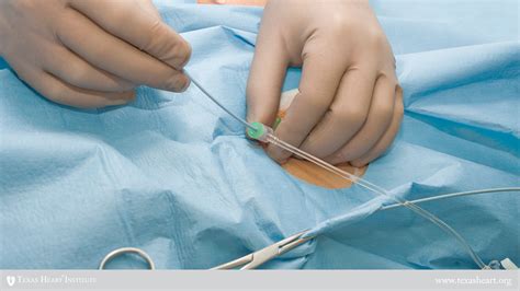 catheterization heart procedure