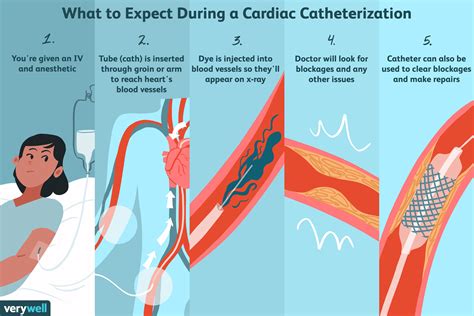 catheterization procedure for the heart
